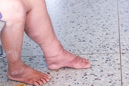 Penyakit Tropis Terabaikan: Kaki Gajah