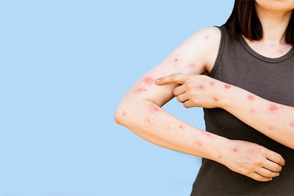 Warning: Kembalinya Cacar Monyet