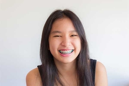 Should I Get Braces?