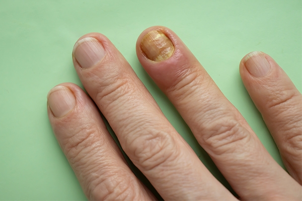 Kenali Luka Kecil di Sekitar Kuku dan Cara Merawatnya