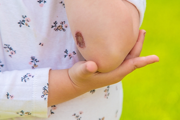 Why Do Scabs Form on Wounds?