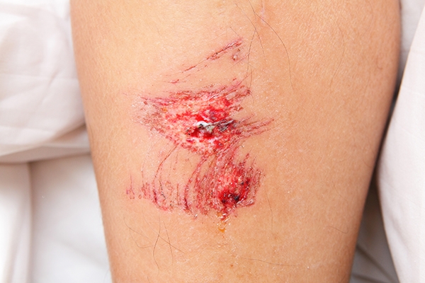 Scabs are the skin's defense against injury.