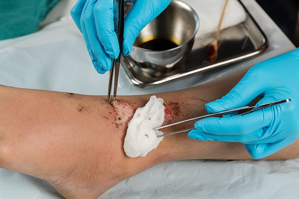 A bleeding scab is one sign of infection.