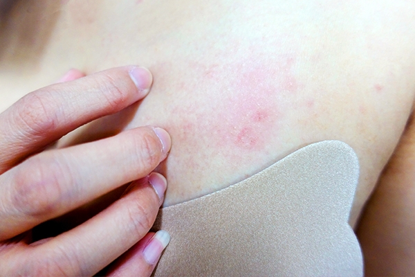 It is important to get checked if the rash does not improve.