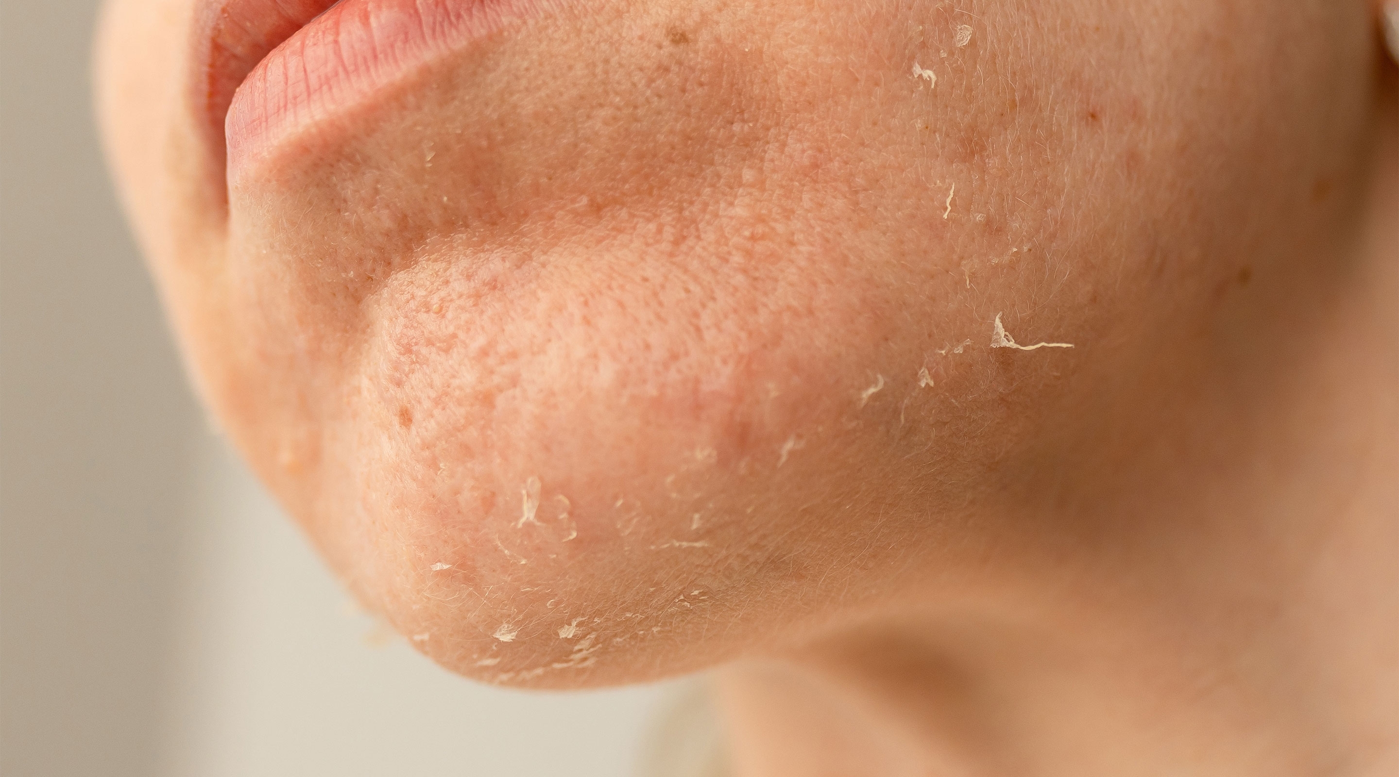 Skin peels easily due to excessive salt consumption.