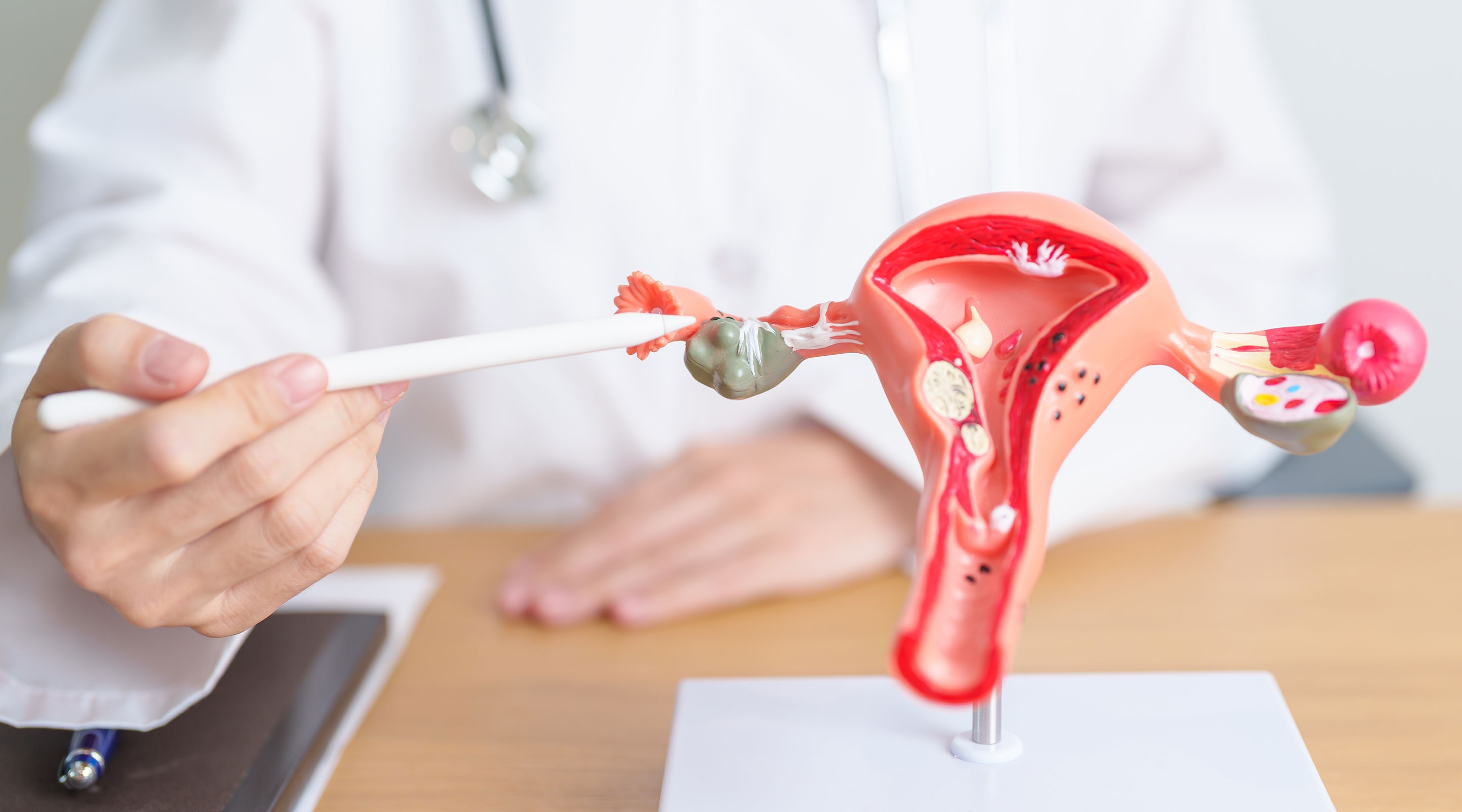 PCOS can be managed with the right strategies to control symptoms and reduce long-term health risks.