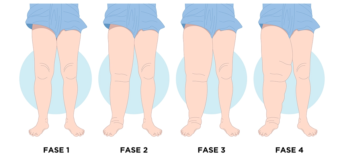 Fase perkembangan penyakit kaki gajah.