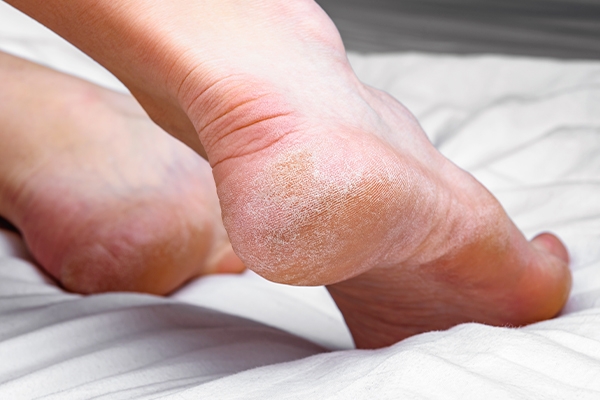 In the early stages, the heels will appear very dry and itchy.