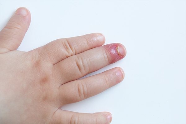 Paronychia is characterized by swelling and redness of the skin around the nail.