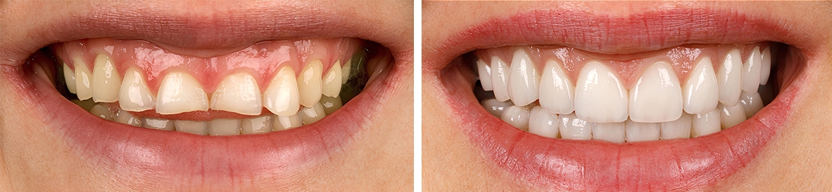 sebelum vs sesudah melakukan prostodonti.
