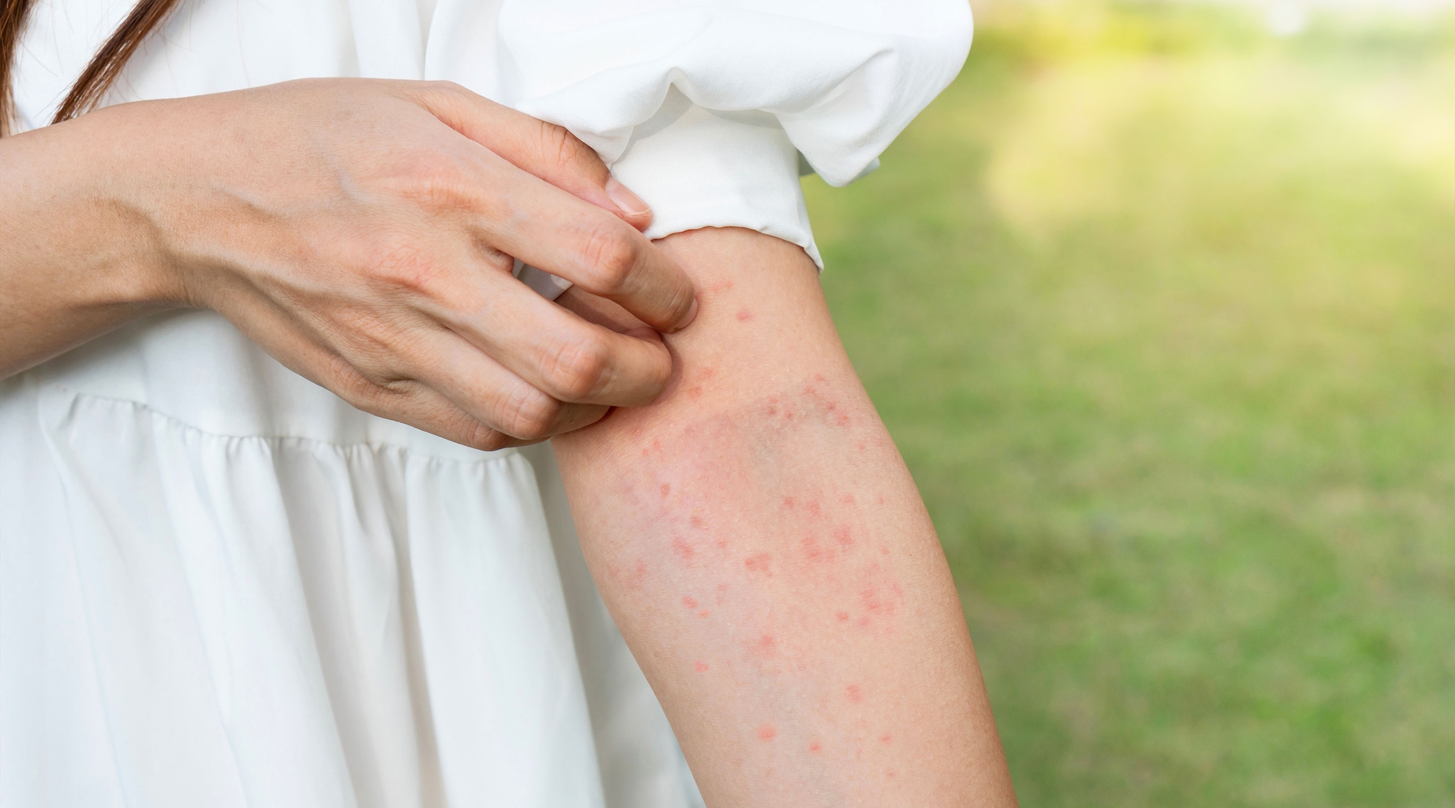 Dermatitis is the most common skin health problem experienced by pilgrims.