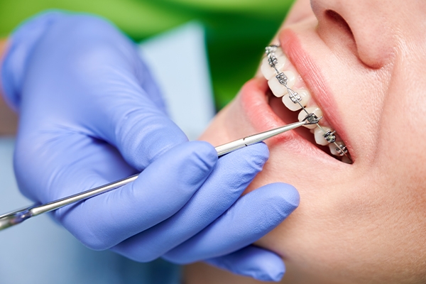 After getting braces, you must have regular check-ups.