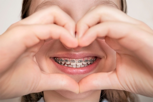 People often choose metal braces because they are more affordable.