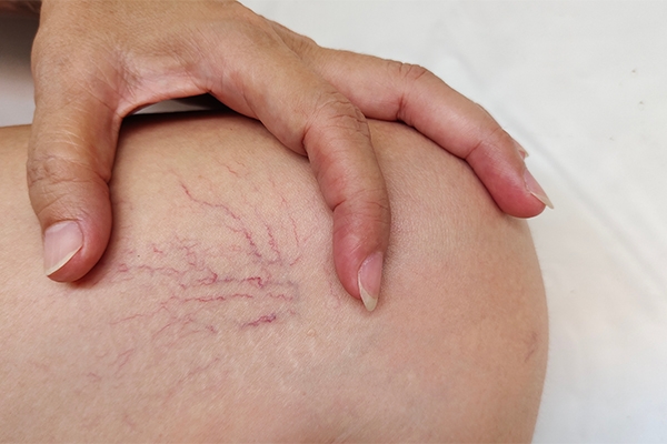 Standing too long can cause spider veins.