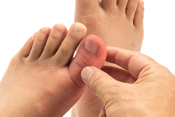 A swollen big toe can be a symptom of gout.