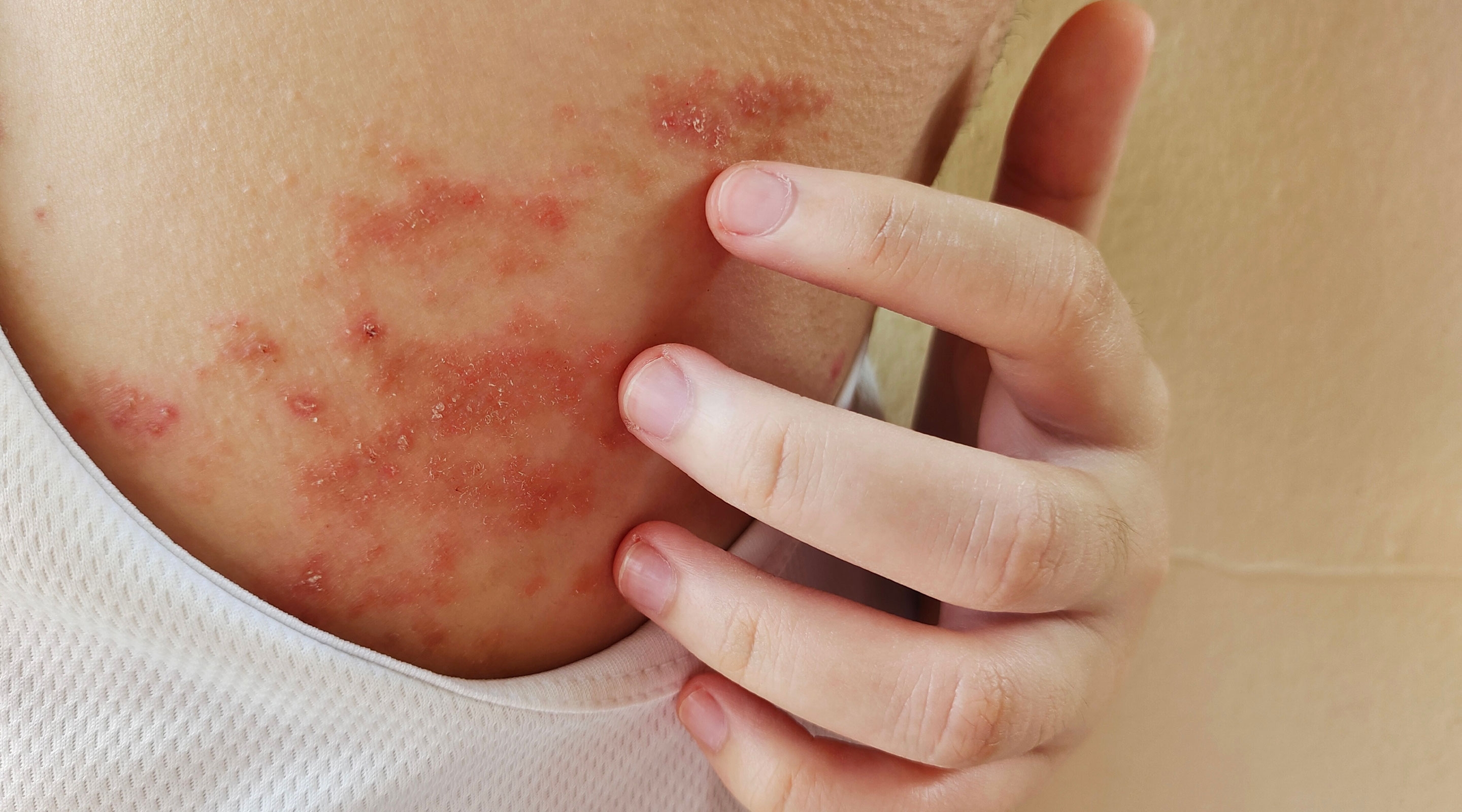 Garam memicu kambuhnya penyakit kulit kronis.