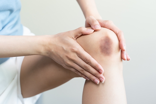 One of the signs of hemophilia is frequent bruising.