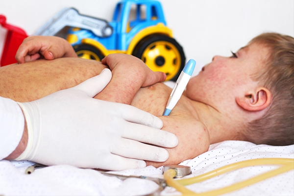 Demam tinggi dan mata merah berair merupakan tanda awal gejala campak.