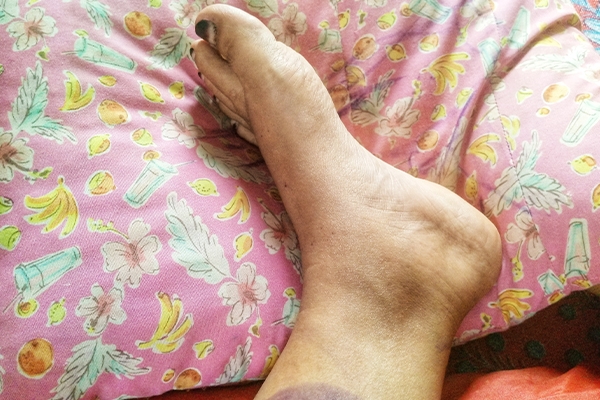 Raising your feet on a pillow is one way to deal with swollen feet.