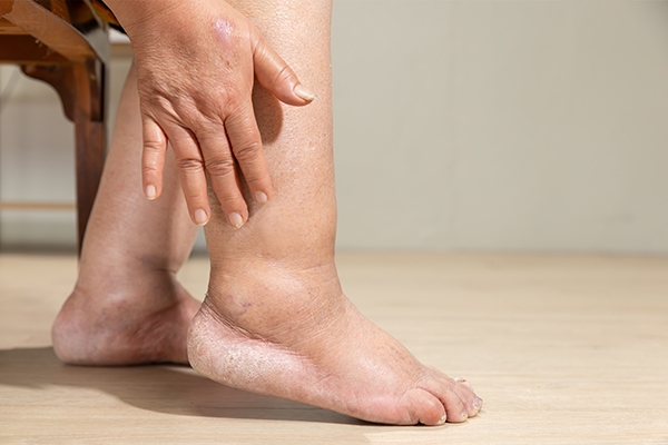 Swollen feet are characterized by a dent when the skin is pressed.