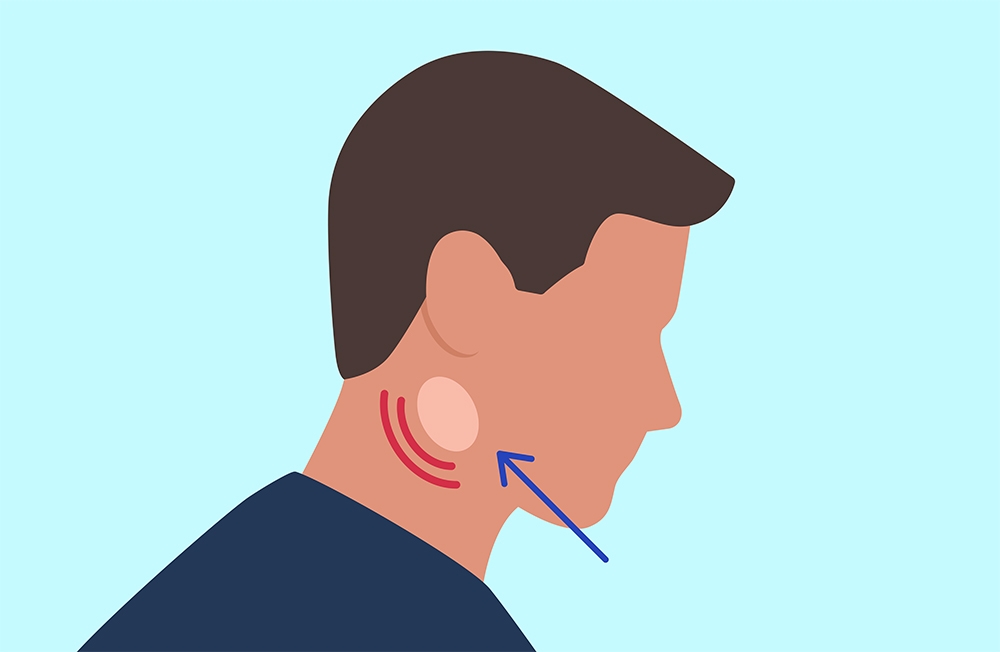 Salah satu gejala leukemia ditandai adanya pembengkakan pada kelenjar getah bening.