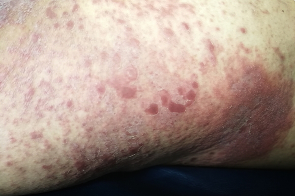 Stevens-Johnson Syndrome Explained: Symptoms, Treatment, and When to ...